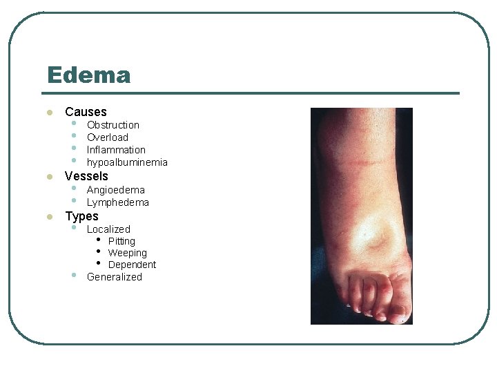 Edema l l l Causes • • Obstruction Overload Inflammation hypoalbuminemia • • Angioedema