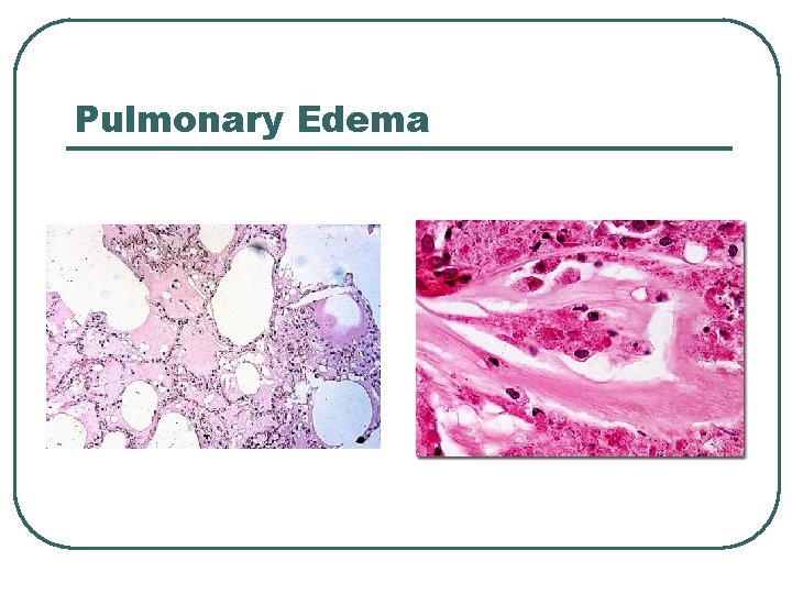 Pulmonary Edema 