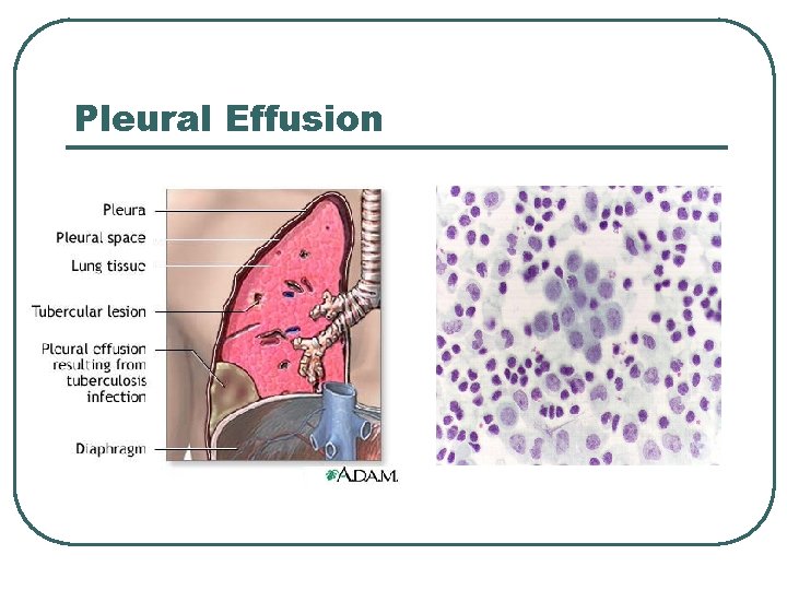 Pleural Effusion 