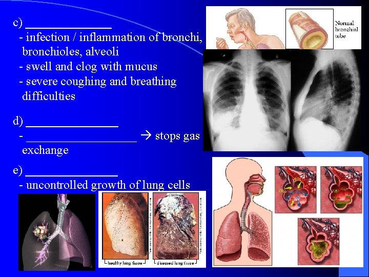 c) _______ - infection / inflammation of bronchi, bronchioles, alveoli - swell and clog