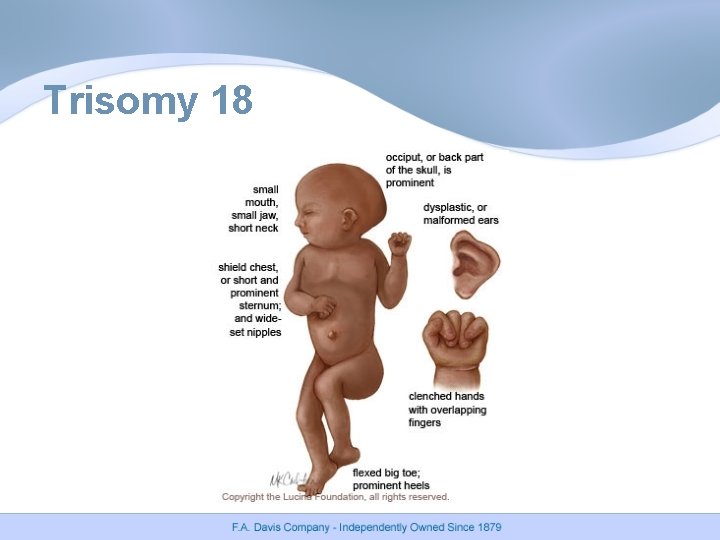 Trisomy 18 