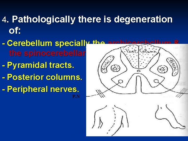 4. Pathologically there is degeneration of: - Cerebellum specially the archicercbcllum & the spinocerebellar