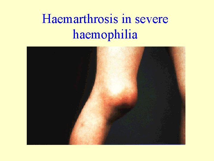 Haemarthrosis in severe haemophilia 