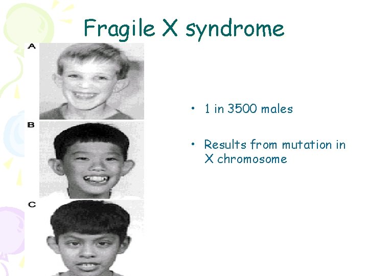Fragile X syndrome • 1 in 3500 males • Results from mutation in X
