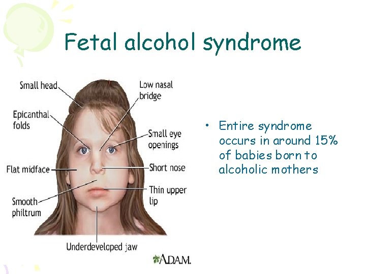 Fetal alcohol syndrome • Entire syndrome occurs in around 15% of babies born to
