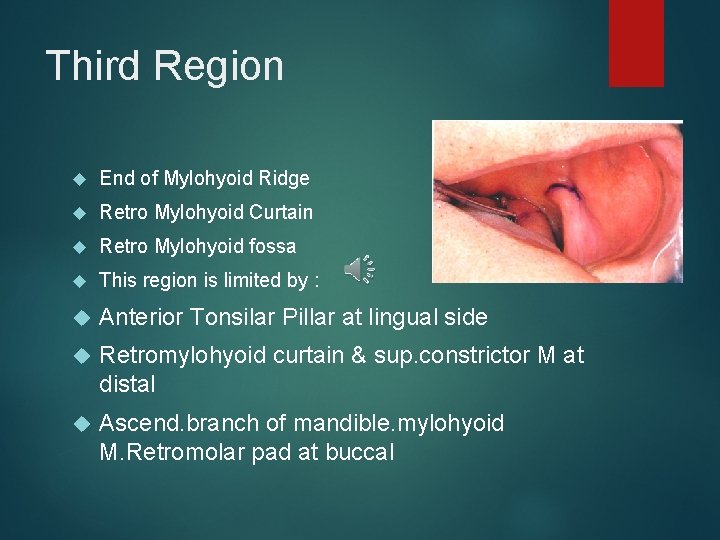 Third Region End of Mylohyoid Ridge Retro Mylohyoid Curtain Retro Mylohyoid fossa This region