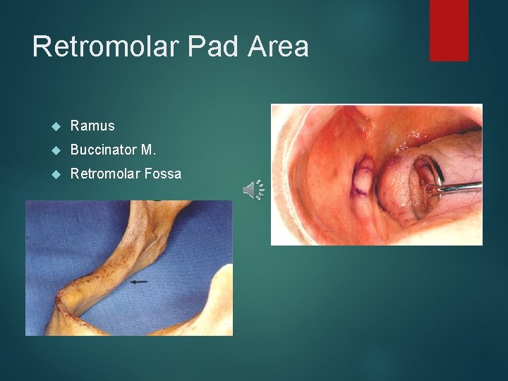 Retromolar Pad Area Ramus Buccinator M. Retromolar Fossa 
