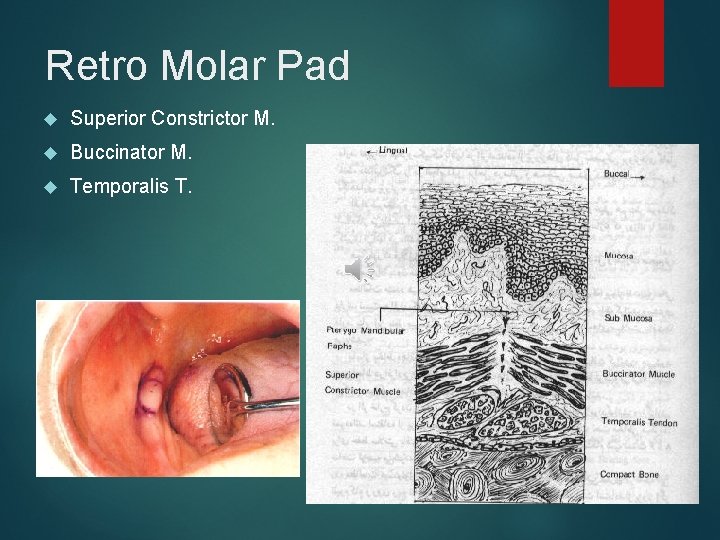 Retro Molar Pad Superior Constrictor M. Buccinator M. Temporalis T. 