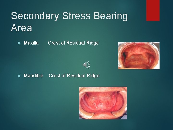 Secondary Stress Bearing Area Maxilla Crest of Residual Ridge Mandible Crest of Residual Ridge
