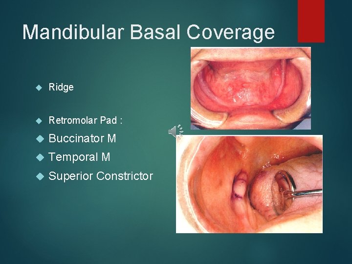 Mandibular Basal Coverage Ridge Retromolar Pad : Buccinator M Temporal M Superior Constrictor 