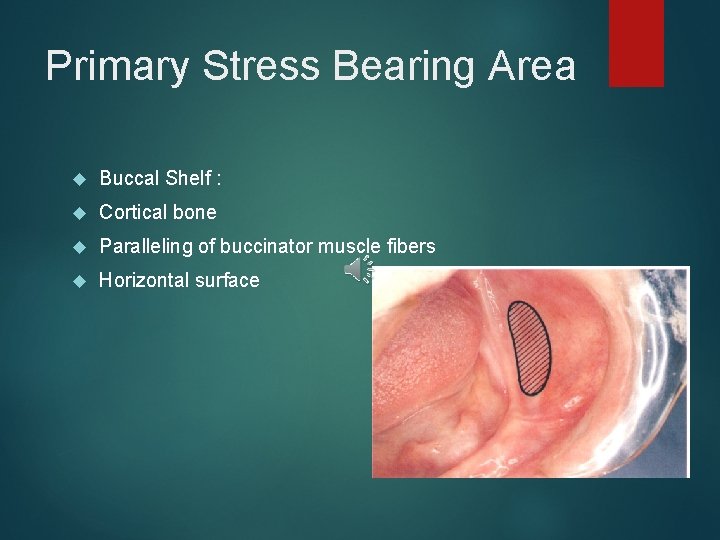Primary Stress Bearing Area Buccal Shelf : Cortical bone Paralleling of buccinator muscle fibers