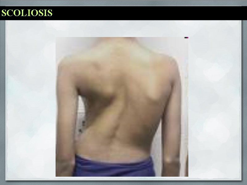 SCOLIOSIS 