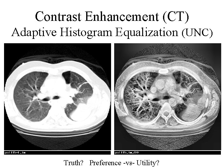 Contrast Enhancement (CT) Adaptive Histogram Equalization (UNC) Truth? Preference -vs- Utility? 