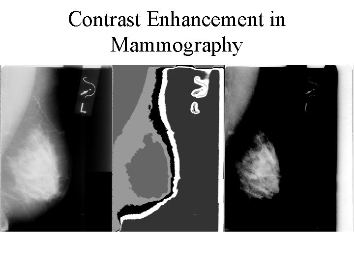 Contrast Enhancement in Mammography 