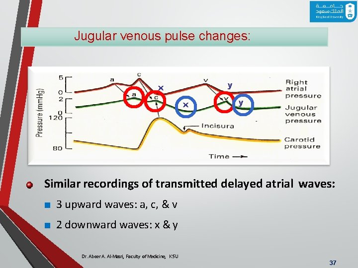 Jugular venous pulse changes: y x x y Similar recordings of transmitted delayed atrial