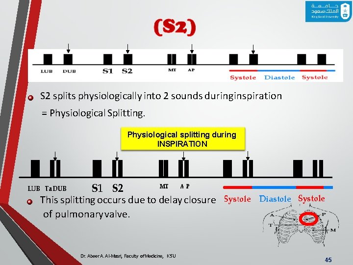 S 2 splits physiologically into 2 sounds duringinspiration = Physiological Splitting. Physiological splitting during