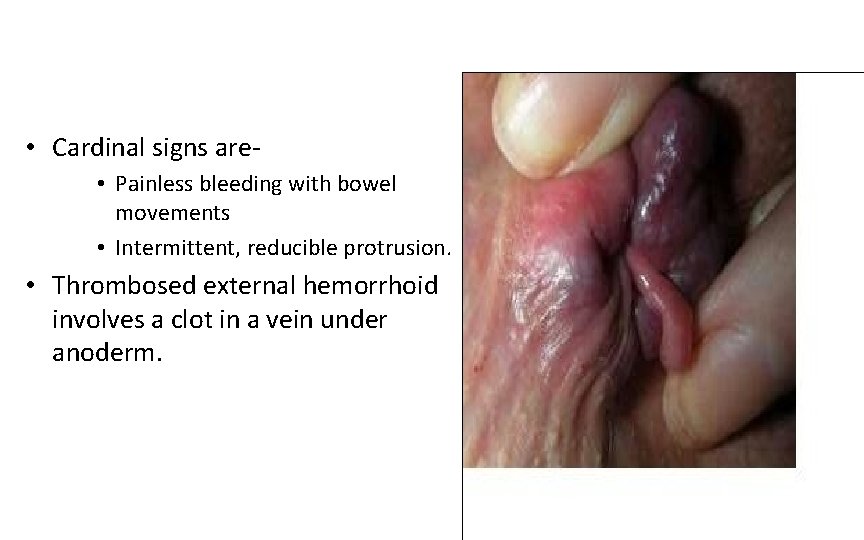  • Cardinal signs are • Painless bleeding with bowel movements • Intermittent, reducible