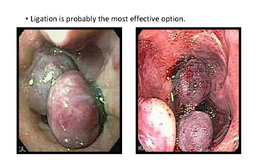  • Ligation is probably the most effective option. 