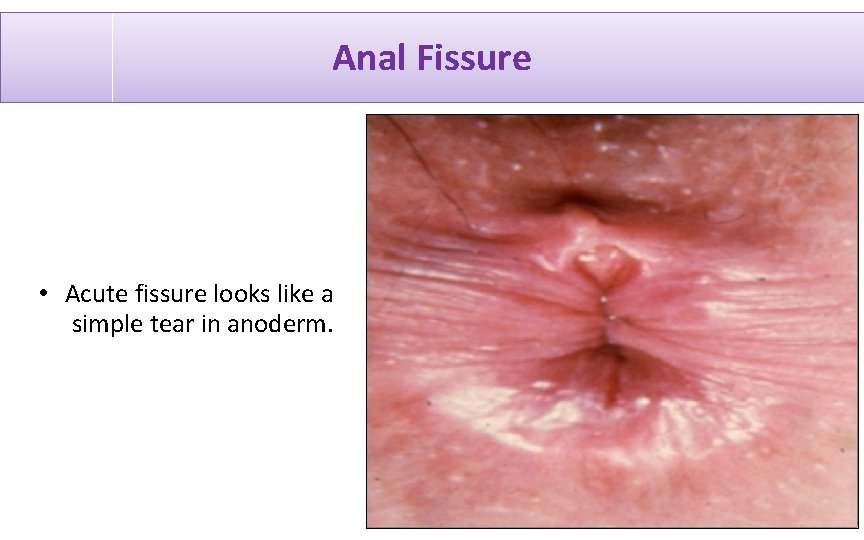 Anal Fissure • Acute fissure looks like a simple tear in anoderm. 