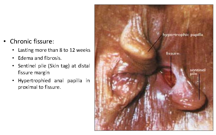  • Chronic fissure: • Lasting more than 8 to 12 weeks • Edema