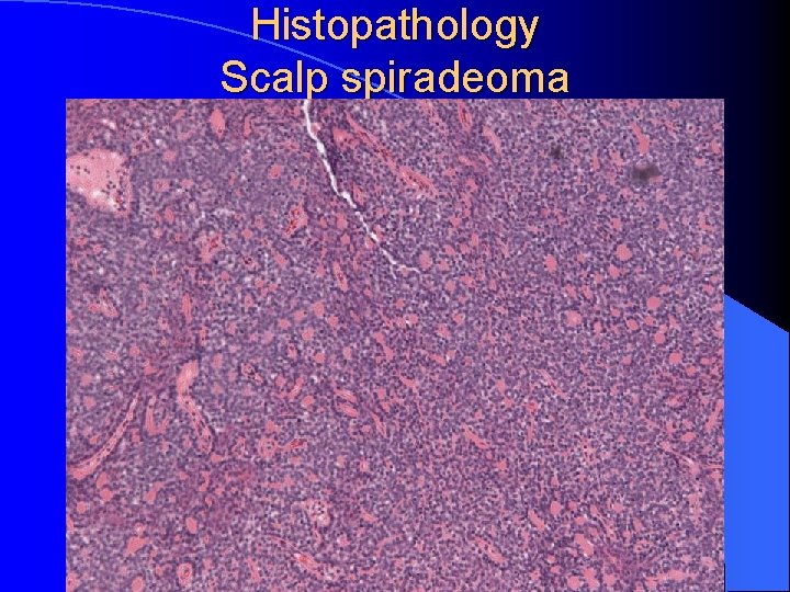Histopathology Scalp spiradeoma 