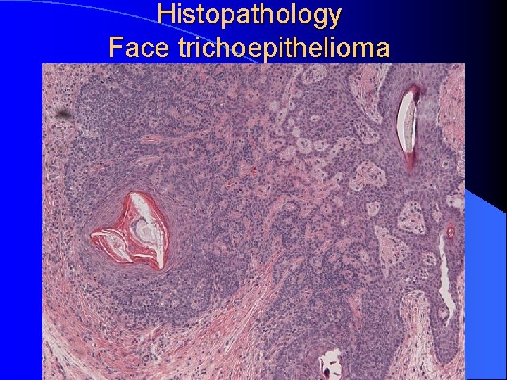 Histopathology Face trichoepithelioma 