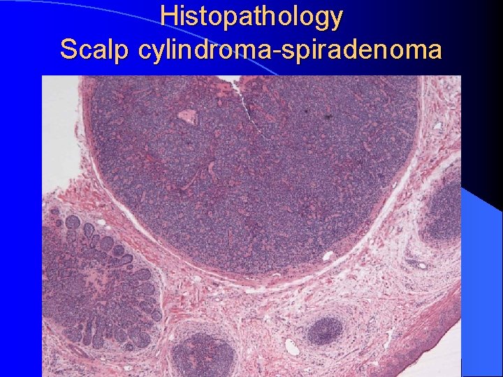 Histopathology Scalp cylindroma-spiradenoma 