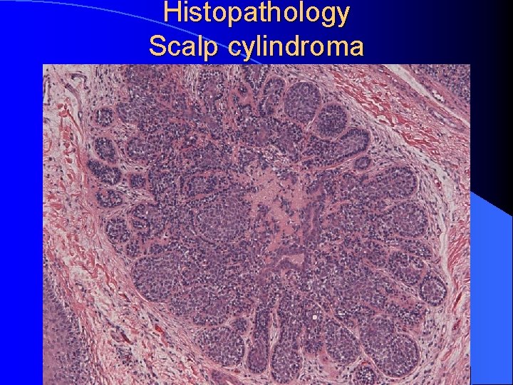 Histopathology Scalp cylindroma 