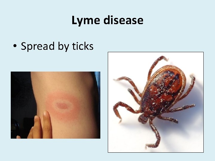 Lyme disease • Spread by ticks 