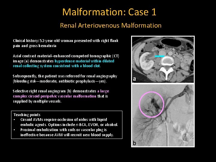 Malformation: Case 1 Renal Arteriovenous Malformation Clinical history: 52 -year-old woman presented with right