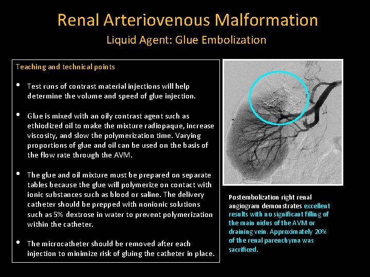Renal Arteriovenous Malformation Liquid Agent: Glue Embolization Teaching and technical points • Test runs