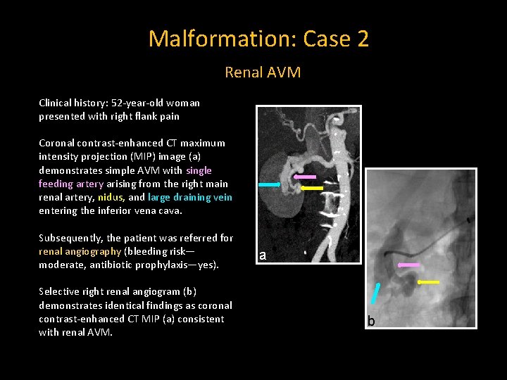 Malformation: Case 2 Renal AVM Clinical history: 52 -year-old woman presented with right flank