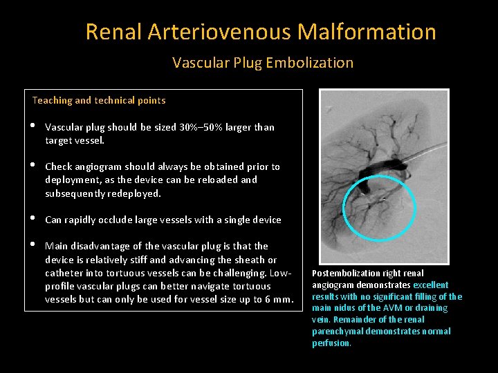 Renal Arteriovenous Malformation Vascular Plug Embolization Teaching and technical points • Vascular plug should