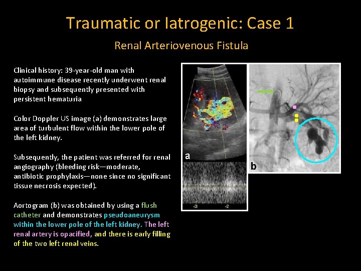 Traumatic or Iatrogenic: Case 1 Renal Arteriovenous Fistula Clinical history: 39 -year-old man with