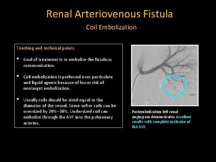 Renal Arteriovenous Fistula Coil Embolization Teaching and technical points • Goal of treatment is