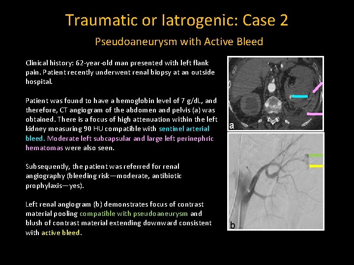 Traumatic or Iatrogenic: Case 2 Pseudoaneurysm with Active Bleed Clinical history: 62 -year-old man