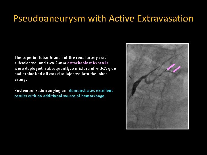 Pseudoaneurysm with Active Extravasation The superior lobar branch of the renal artery was subselected,
