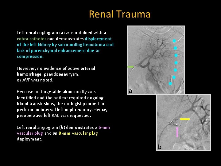 Renal Trauma Left renal angiogram (a) was obtained with a cobra catheter and demonstrates