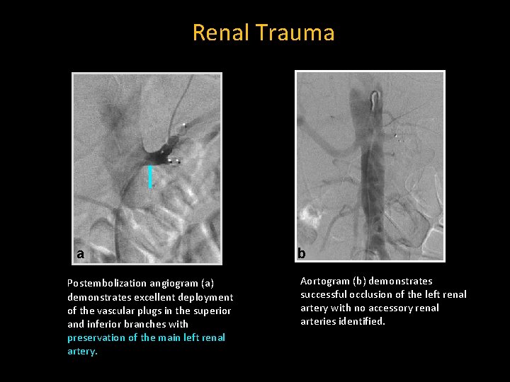 Renal Trauma a Postembolization angiogram (a) demonstrates excellent deployment of the vascular plugs in