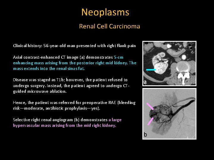 Neoplasms Renal Cell Carcinoma Clinical history: 56 -year-old man presented with right flank pain