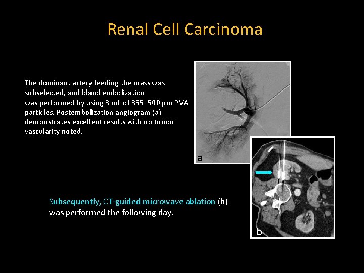 Renal Cell Carcinoma The dominant artery feeding the mass was subselected, and bland embolization