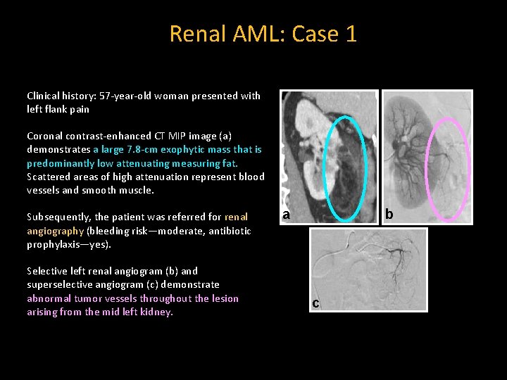 Renal AML: Case 1 Clinical history: 57 -year-old woman presented with left flank pain