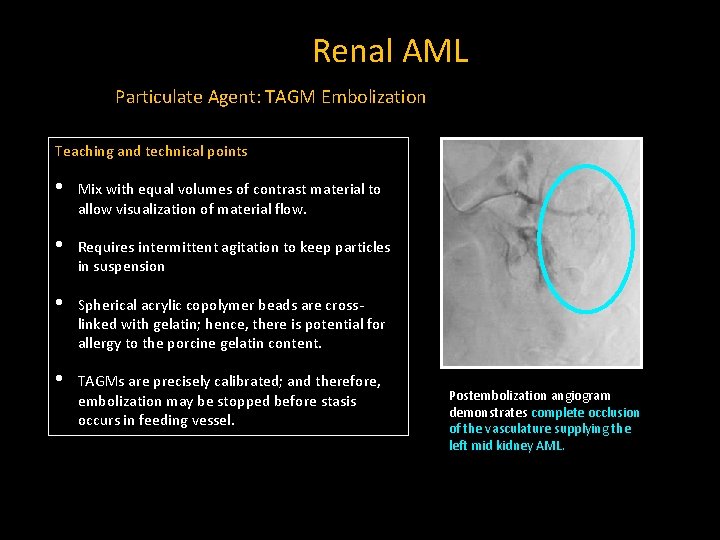 Renal AML Particulate Agent: TAGM Embolization Teaching and technical points • Mix with equal