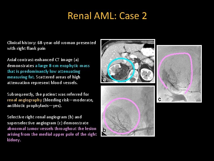 Renal AML: Case 2 Clinical history: 68 -year-old woman presented with right flank pain
