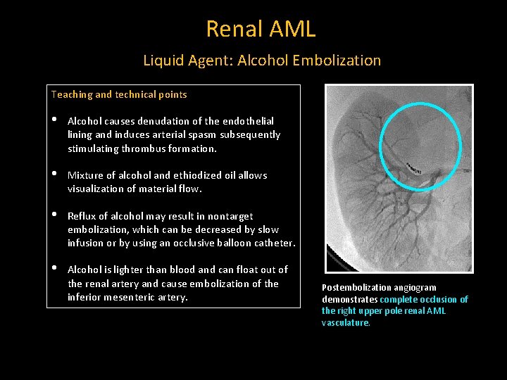 Renal AML Liquid Agent: Alcohol Embolization Teaching and technical points • Alcohol causes denudation