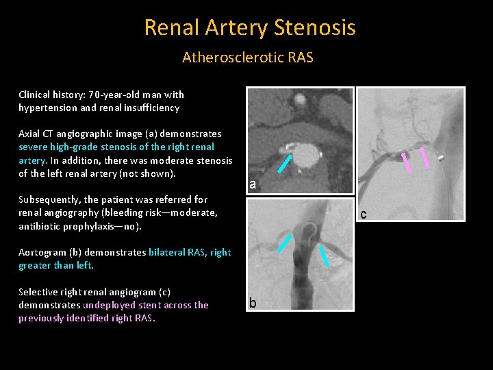 Renal Artery Stenosis Atherosclerotic RAS Clinical history: 70 -year-old man with hypertension and renal