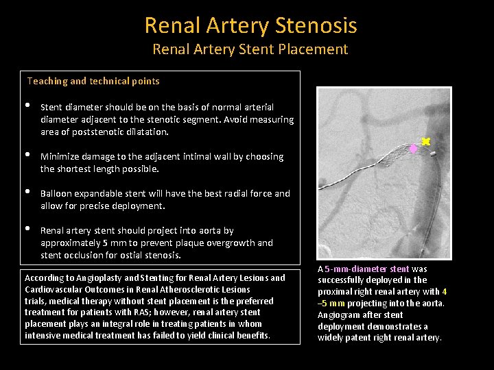 Renal Artery Stenosis Renal Artery Stent Placement Teaching and technical points • Stent diameter