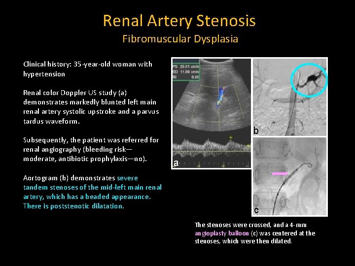 Renal Artery Stenosis Fibromuscular Dysplasia Clinical history: 35 -year-old woman with hypertension Renal color