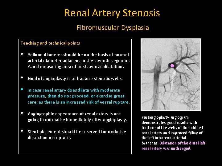 Renal Artery Stenosis Fibromuscular Dysplasia Teaching and technical points • Balloon diameter should be