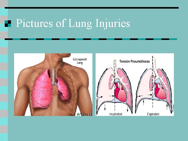 Pictures of Lung Injuries 